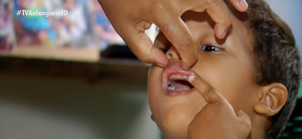 Menino que precisa extrair todos os dentes após cáries consegue consulta com especialista para continuar tratamento dentário